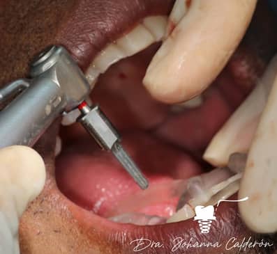 Slider image (2) Dental Implants in Colombia Dr Johanna Calderon